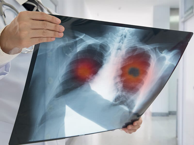 miniature-questions-de-santé-liées-au-benzène